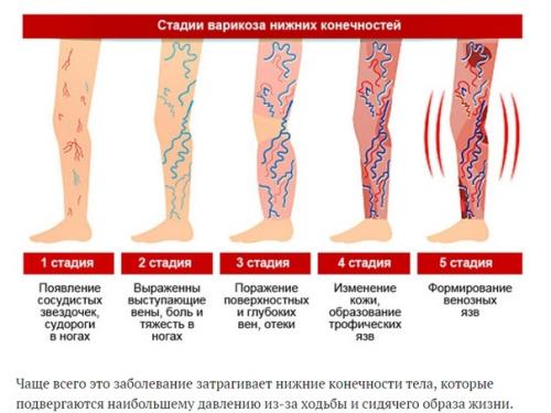 Варикоз Нижних Конечностей Екатеринбург