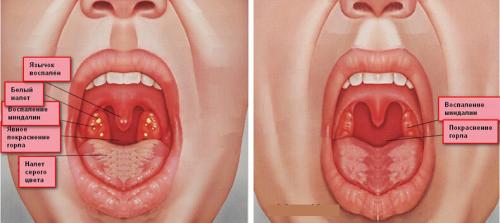 Поза льва упражнение для очищения миндалин. «Поза льва» — упражнение для очищения миндалин