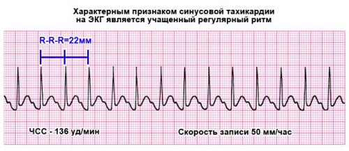 Нейроциркуляторная дистония по смешанному типу, что это такое. Нейроциркуляторная дистония по смешанному типу: что это такое, симптомы, причины и методы лечения