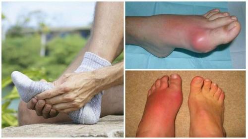 Подагра на ноге. Причины