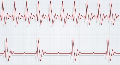 Вегето-сосудистая дистония мк.  Код всд по мкб-10: вегетососудистая дистония по смешанному типу, причины, лечение