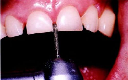 Сепарация зубов. Secondary Navigation Menu