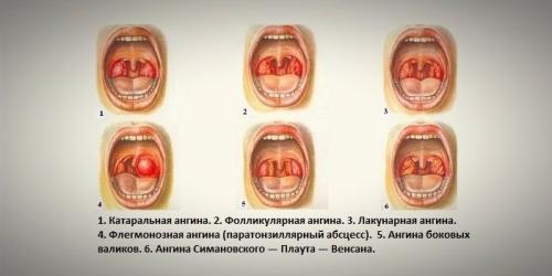 Лекарство от сильной боли в горле взрослым. Чем вылечить боль в горле при глотании: топ самых эффективных средств