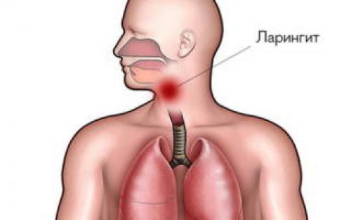 Лекарство от сильной боли в горле взрослым. Чем вылечить боль в горле при глотании: топ самых эффективных средств