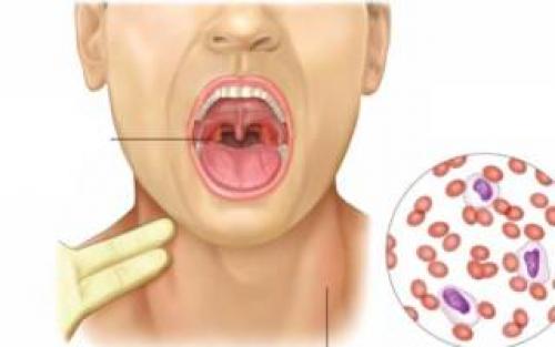 Лекарство от сильной боли в горле взрослым. Чем вылечить боль в горле при глотании: топ самых эффективных средств