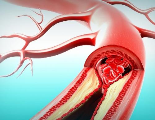 Осложнения гипертонического криза таблица. Последствия и осложнения гипертонического криза у мужчин и женщин