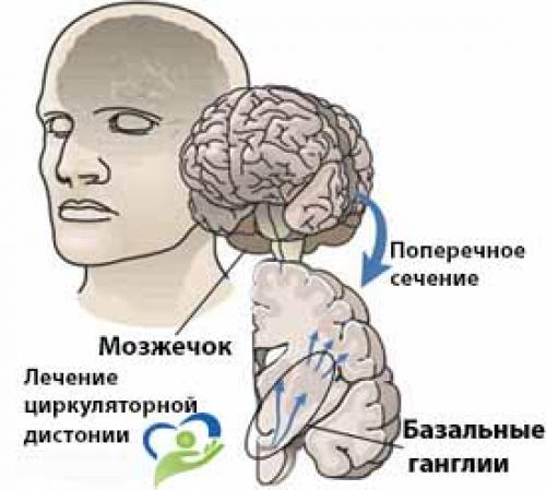 Нейроциркуляторная дистония карта вызова