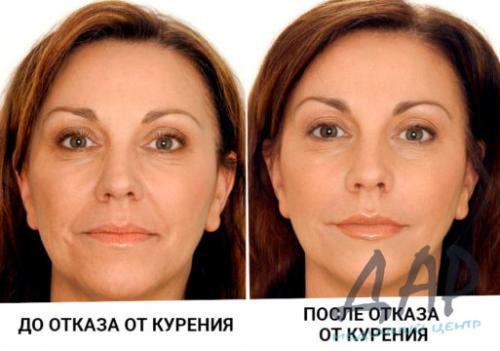 Кодирование от курения днепр. Кодировка от курения — эффективный способ избавления от никотиновой зависимости