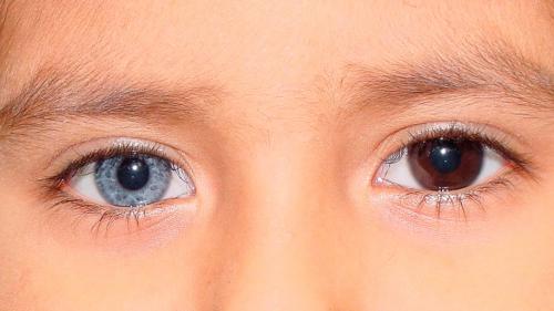 И у мужчин бывают разные глаза. Глаза разного цвета