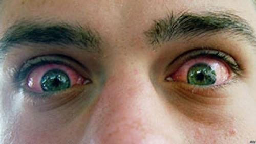 Почему расширяются зрачки от наркотиков. Как по глазам определить, какой наркотик употребляет ваш близкий?