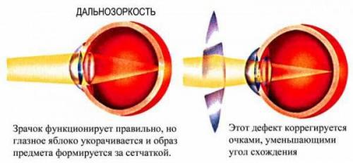 Суженные зрачки. Причины возникновения