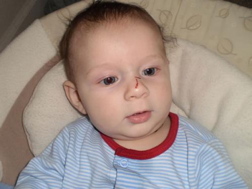 Я ударила своего ребенка в порыве агрессии пошла кровь из носа. Что делать, если ребенок упал и ударился носом