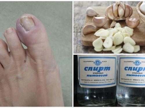 Чеснок от грибка. Как использовать чеснок от грибка ногтей