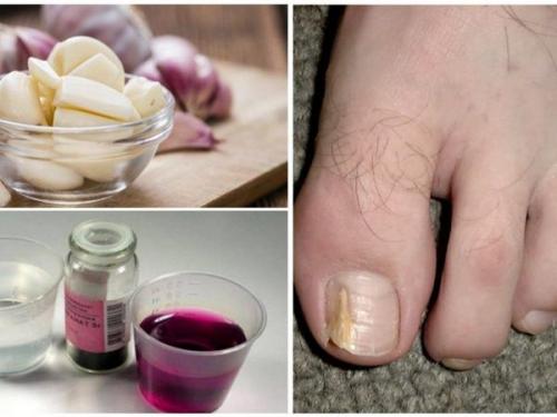 Чеснок от грибка. Как использовать чеснок от грибка ногтей