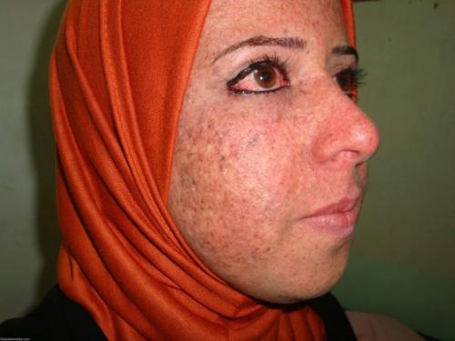 Боязнь солнечного света. Как проявляется светобоязнь 02