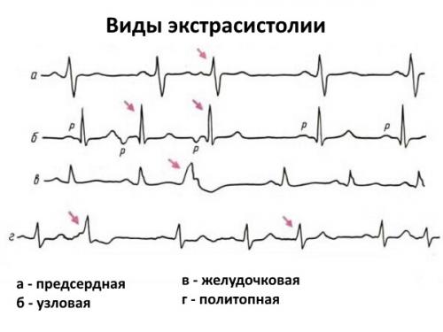 НЦД по кардиальному типу лечение. Кардиальный тип