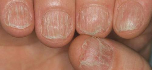 Выпадение волос у молодых мужчин. Симптомы выпадения волос 06