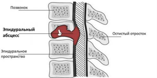 Как избавиться от боли в пояснице'' (мгновенно). Специфические причины болей в спине