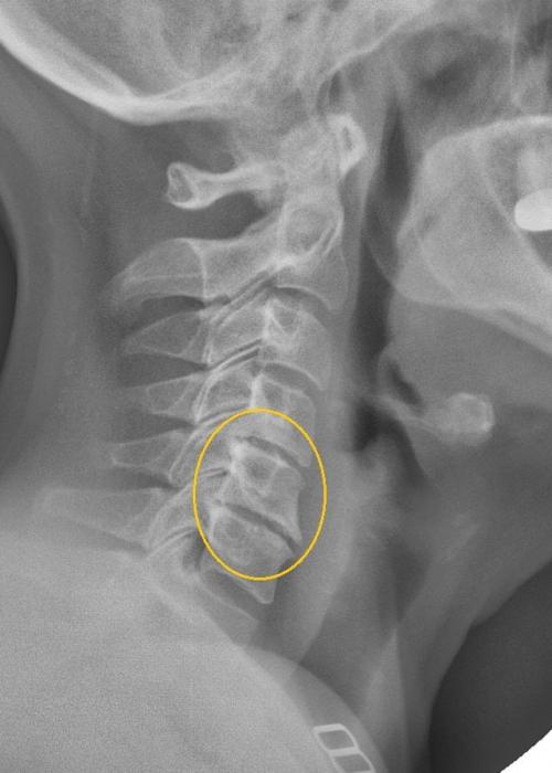 Давит в горле ниже кадыка, что делать. Боль в горле при шейном остеохондрозе: как диагностировать, чем лечить