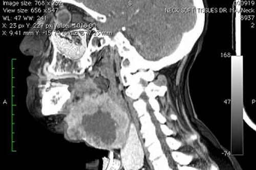 11 причин ощущения кома в горле и методы лечения. Причины 01