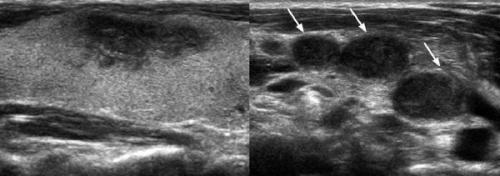 Визуальные признаки нарушений щитовидной железы. Причины заболеваний щитовидной железы 06