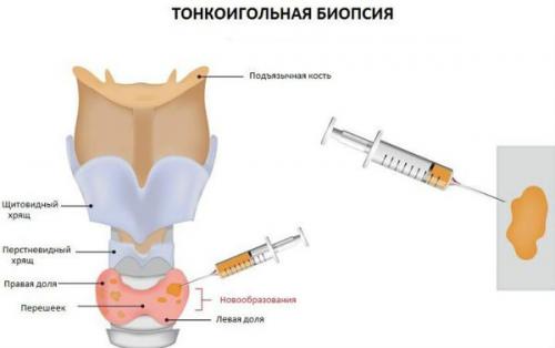 Визуальные признаки нарушений щитовидной железы. Причины заболеваний щитовидной железы 08