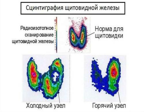 Визуальные признаки нарушений щитовидной железы. Причины заболеваний щитовидной железы 07