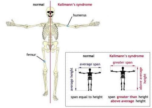 Span height. Синдром Кальмана симптомы. Синдром Клайнфельтера, синдром Кальмана.. Синдром Каллмана у женщин.