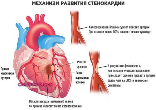 Из-за чего может остановиться сердце у подростка. Причины замирания сердца, симптомы требующие обращения к врачу и методы лечения