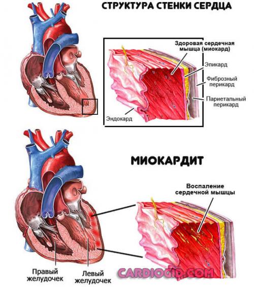 Из-за чего может остановиться сердце у подростка. Причины замирания сердца, симптомы требующие обращения к врачу и методы лечения