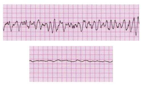 Признаки остановки сердца. Патогенез
