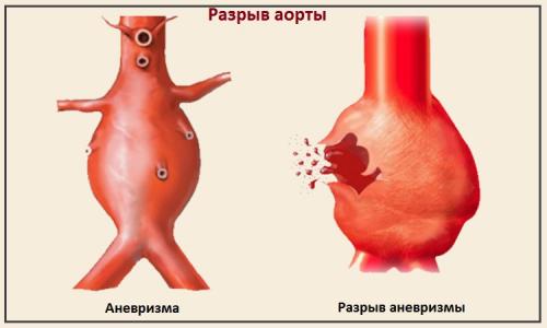 Разрыв сердца от страха причины. Что представляет собой болезнь?