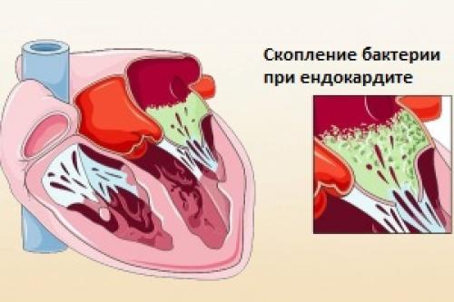 Разрыв сердца от испуга. Причины