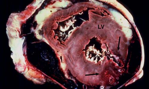 Разрыв сердца от страха причины. Причины и разновидности разрыва сердца