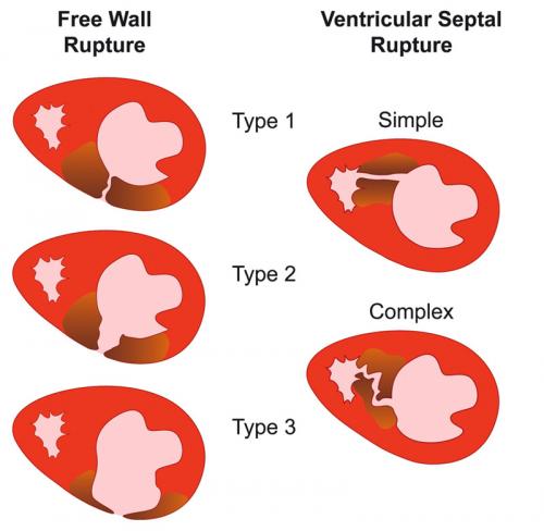 Разрыв сердца от страха причины. Причины и разновидности разрыва сердца