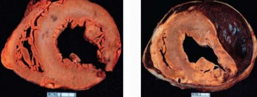 Разрыв сердца от страха причины. Причины и разновидности разрыва сердца