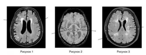 Какие заболевания могут быть связаны с верхними долями полушарий головного мозга