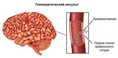 10 главных упражнений для тех. Как избавиться от спазмов сосудов головного мозга 03
