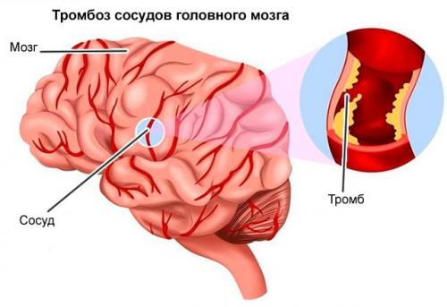 10 главных упражнений для тех. Как избавиться от спазмов сосудов головного мозга 02