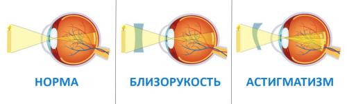 Глаза болят от яркого света, что делать. Патологические