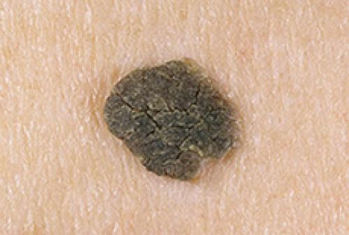 Как убрать возрастные пигментные пятна. Виды пигментных пятен 02