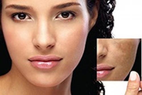 Как убрать возрастные пигментные пятна. Виды пигментных пятен 01