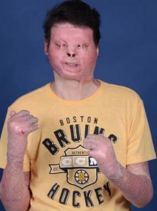 Этот американец стал первым в истории, кому смогли пересадить лицо и обе руки. 02