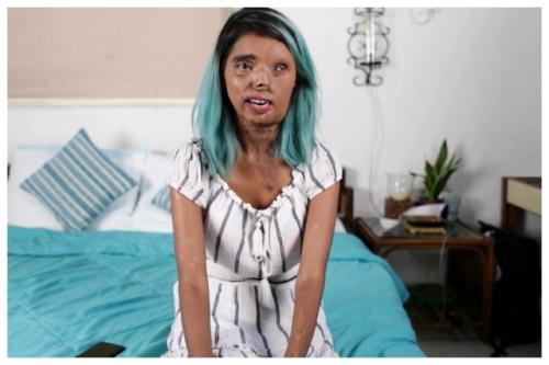 23-Летняя девушка, которую отец облил кислотой, в данный момент стремится стать моделью. 01