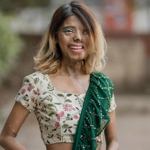 23-Летняя девушка, которую отец облил кислотой, в данный момент стремится стать моделью. 
