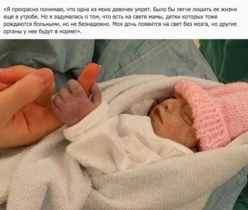 Невероятная история.  Женщина родила двойняшек, заранее зная что одна из низ погибнет при рождении из-за болезни! 02