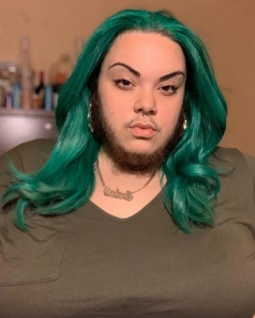 Альма торес, девушка у которой в 15 лет произошел гормональный сбой, и у неё начали расти лишние волосы на лице. 03