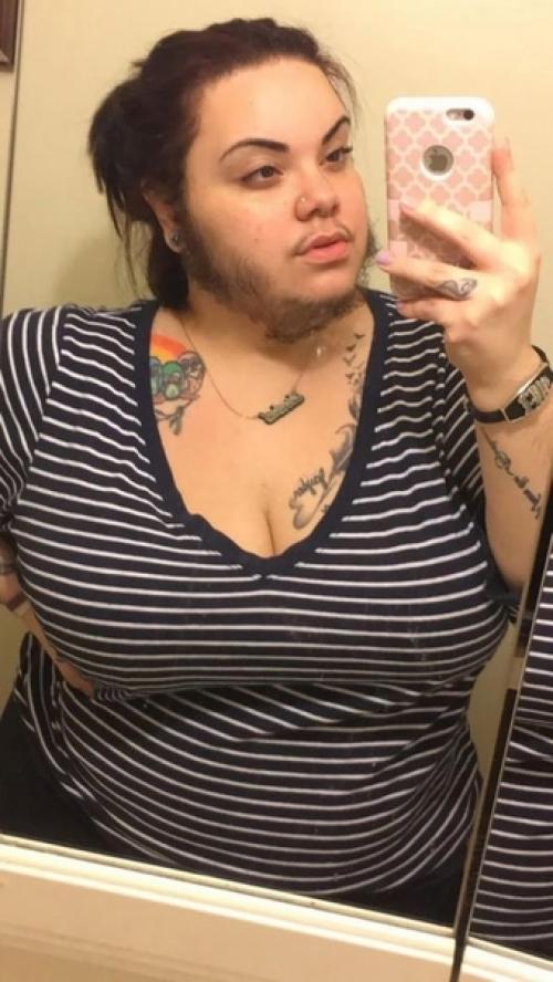 Альма торес, девушка у которой в 15 лет произошел гормональный сбой, и у неё начали расти лишние волосы на лице. 01