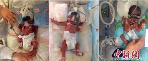 Китаянка знала, что ждёт тройню, когда забеременела в августе 2016 года. 01