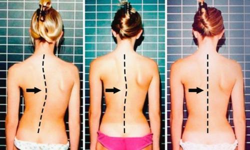 7 упражнений для спины, которые избавят от искривления и болей в спине.